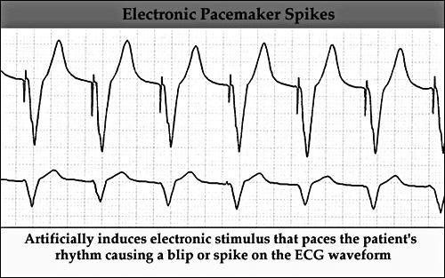 Implanted Pacemaker Most set on demand When the heart rate