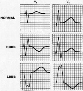 3 mv) or more in lead avl is another sign of LVH Others: Cornell criteria