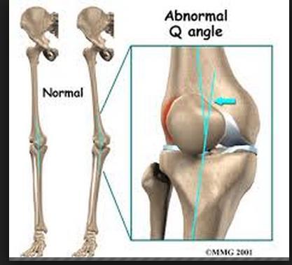 Weak hip abductors leads to lateral