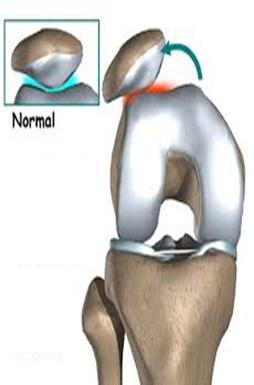 Knee Peroprioception The increase in absolute angular error noted in knee proprioception after fatigue protocol of hip