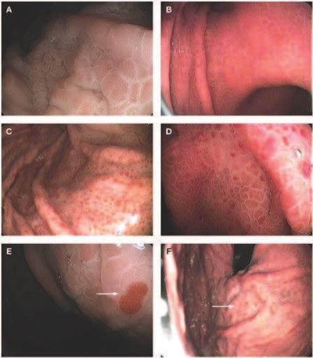 66 Stomach Disorders Figure 1. Endoscopic images of portal hypertensive gastropathy that show the four main indings of this condition.