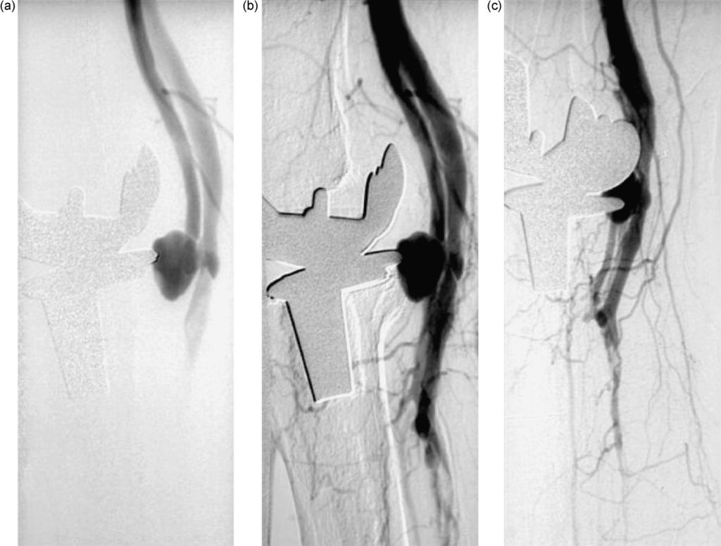 12 N. E. Manghat et al. Fig. 2. Digital subtraction angiography. (a) The popliteal pseudoaneurysm and AVF with early filling of the popliteal vein.