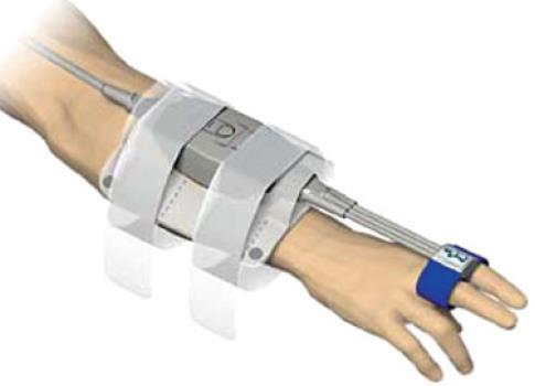Continuous Noninvasive Arterial Blood Pressure Measurement (CNAP) CNAP uses pairs of sensor cuffs, which are placed on adjacent fingers Only one cuff is