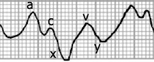 Beginning of the ventricular contraction (c-wave)