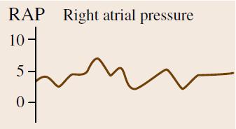 Pressure (PCWP) To