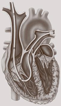 Pulmonary Artery Pressure (PAP) and Pulmonary Capillary Wedge Pressure (PCWP) Correct catheter position is reached once in wedge position That is, once the inflated balloon of the catheter blocks off