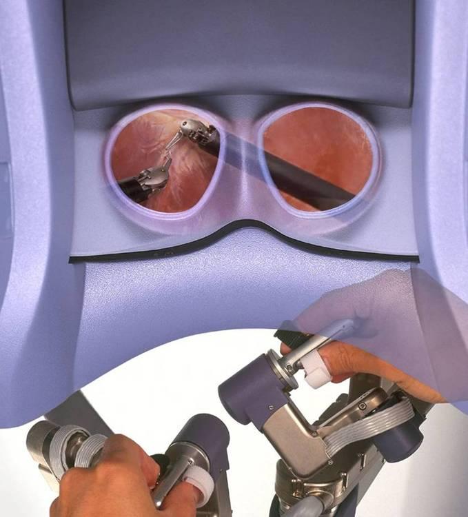lenses laparoscope 3D, high