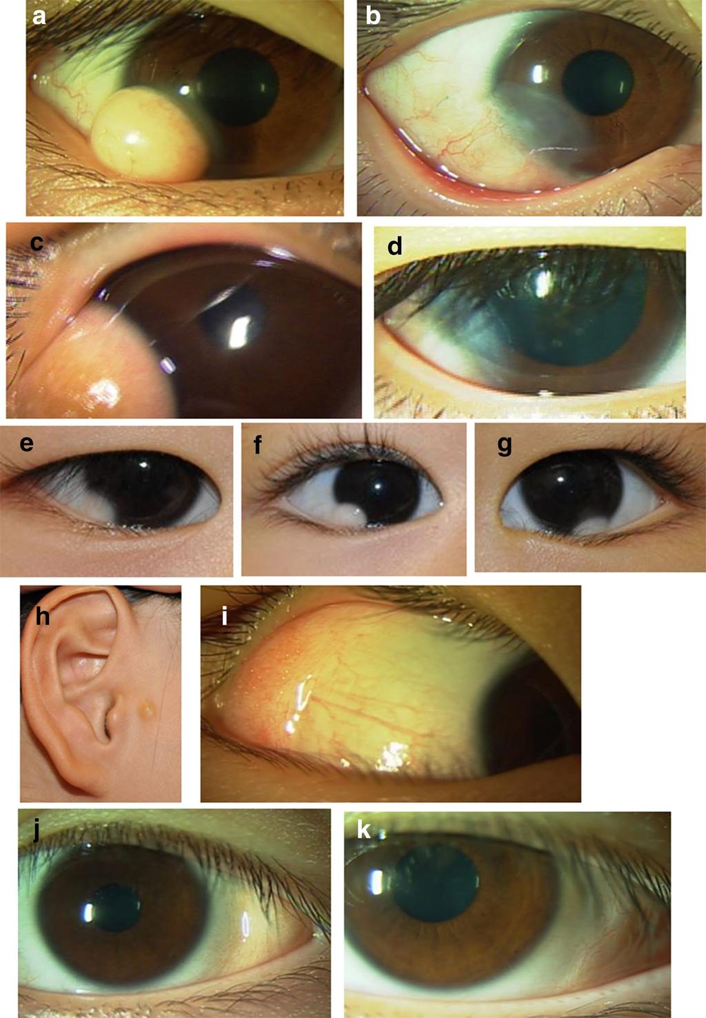 Page 5 of 8 Fig. 1 Case 4 (18-year-old male) with limbal dermoid (a) in the right eye, and 3 months after the resection (b).