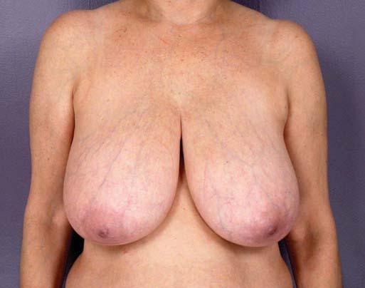 A B C D Figure 11. A, C, Preoperative views of a 60-year-old woman. B, D, Postoperative views 6 months after laser-assisted breast reduction with removal of 640 g bilaterally.