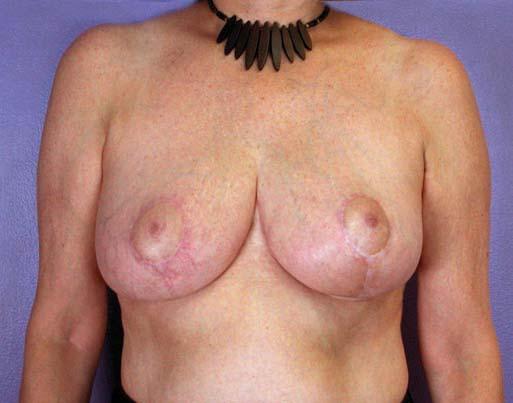 Preoperative sternal notch to nipple distances ranged from 22 to 54 cm, with the most common measurement being between 26 and 30 cm (Figure 4).