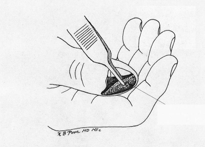 (C) The wound healed esthetically without scar contracture at 2-week follow-up. useful for coverage of acute hand injuries, but two stages are required for flap attachment and division.