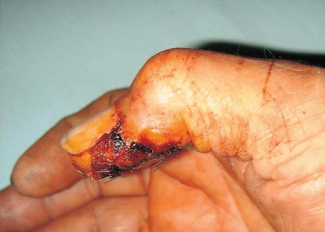 of the primary suture for the fingertip defect around the distal interphalangeal joint.