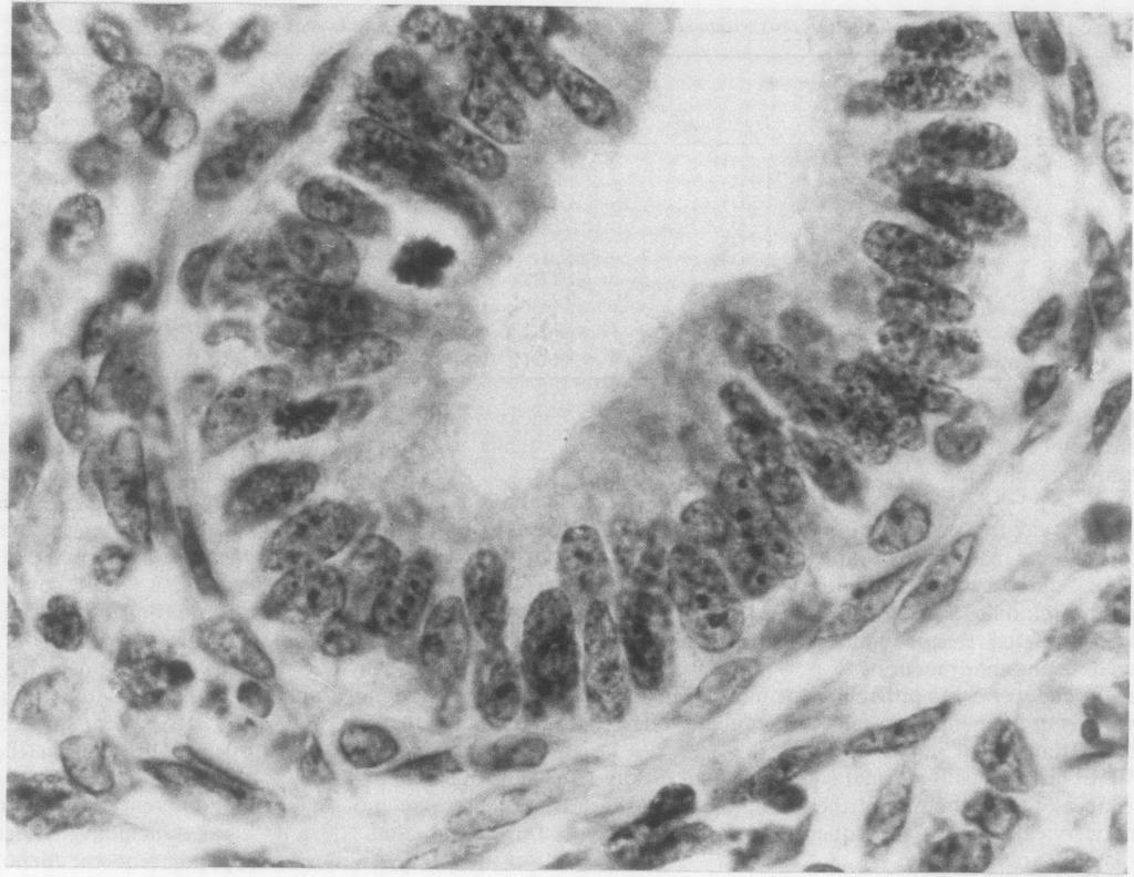 1278 AA.,.e, Fig 1 Cullimore, Rollason, Marshall Adenocarcinoma in situ ofcervical gland crypts stained by AgNOR technique. Multiple small NORs are seen in nucleii. other conditions.