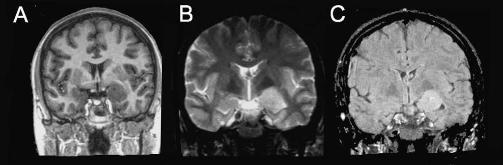 310 B. Diehl et al. Fig. 1: MRI of a 22 years woman with intractable temporal lobe epilepsy secondary to a hamartoma.