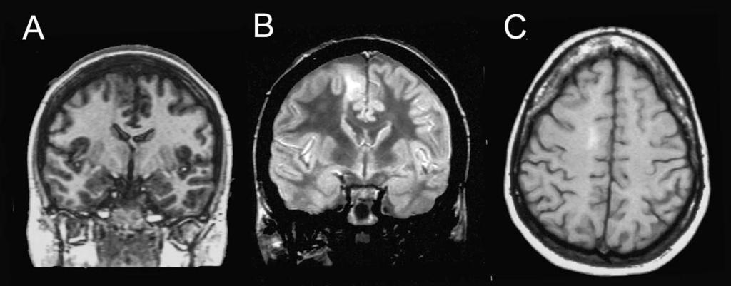 Signal characteristics are: isointense on T1 (A), hyperintense on T2 and FLAIR (B and C). Fig. 2: MRI of a 33-year-old woman with bilateral asymmetric tonic seizures since the age of 11 years.
