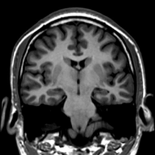 Hippocampal Sclerosis 1 st sign: abnormal
