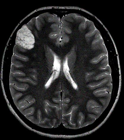Medial temporal lobe (MCC
