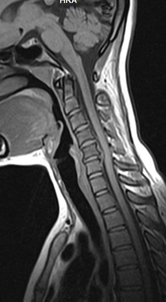 In our study spinal cord compression and myelopathic changes was noted in 43(5.7%) patients. Most of the patients with myelopathic changes were males 39(8.5%) with only 4(1.