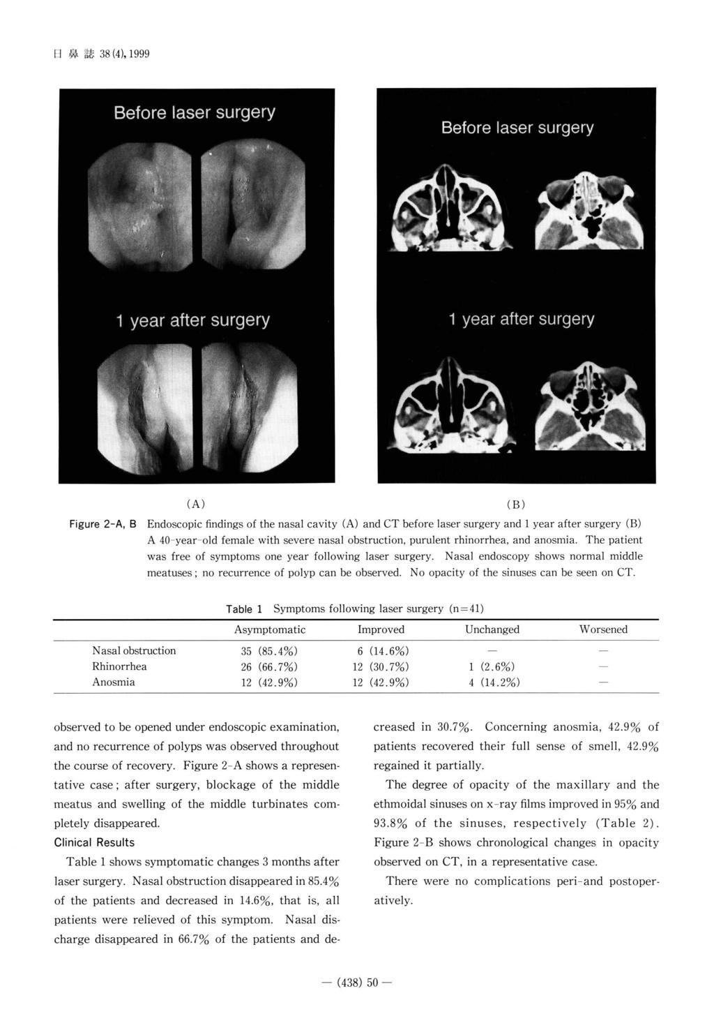日 鼻 誌38(4), 1999 Figure 2-A, B findings of the nasal cavity A 40-year-old female was free of symptoms es; (A) and CT before laser surgery with severe nasal one year no recurrence obstruction,