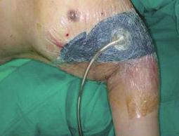 Afterwards, split-thickness skin graft was performed over this skin area and negative pressure wound therapy was simultaneously performed.