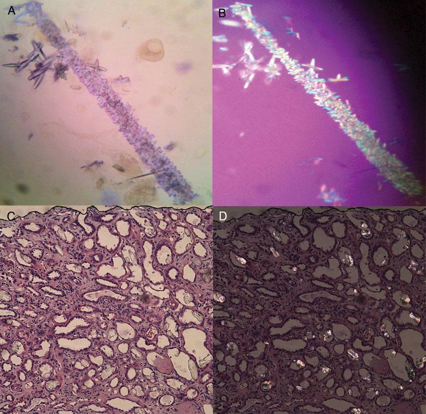132 R.L. Luciano and M.A. Perazella Fig. 1. Acute calcium oxalate nephropathy from ethylene glycol intoxication.