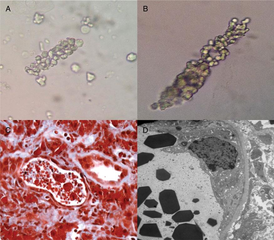 Editorial Comment 133 Fig. 2. Myeloma LC crystalline-induced kidney injury. (A and B) Urine sediment reveals monoclonal LC casts under light microscopy ( 400).