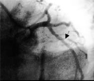 during hyperdynamic movement of the left ventricular walls, showing the anterior-apical and lateral areas of hypoperfusion (dark arrows).