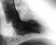 A number of echocardiographic contrast agents for intravenous use are in the clinical experimental stages.