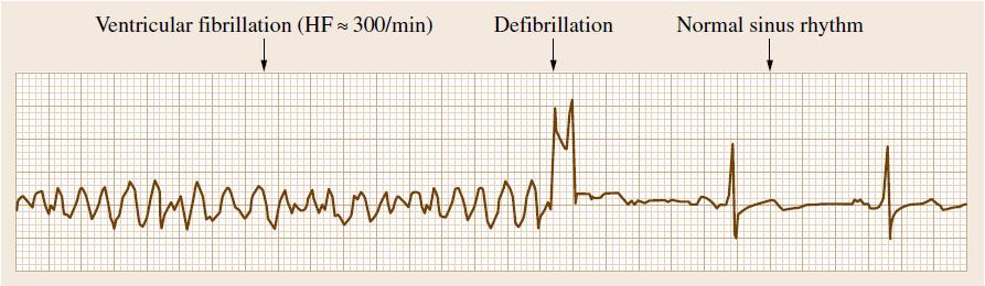 Defibrillator Theory of Operation Defibrillators are electrotherapeutic high-voltage devices which are used within course of resuscitation and to terminate tachycardic ventricular and