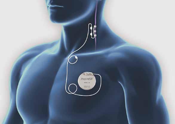 About VNS Therapy Vagus Nerve Generator The VNS Therapy device sends a mild pulse through the vagus nerve to areas of the brain that are associated with seizures in an effort to control your seizures.