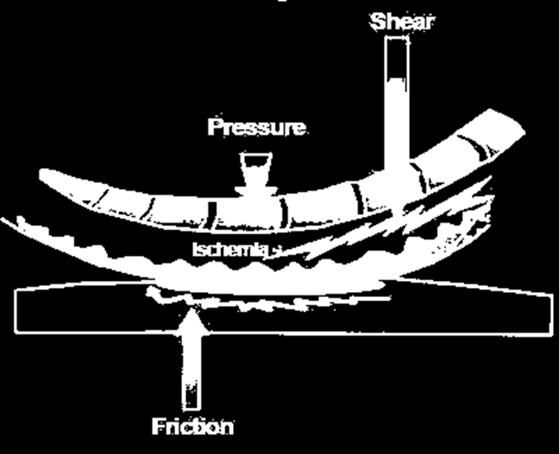 Friction: Friction damage occurs when the epidermal layer of the skin is damaged