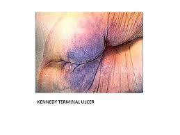 These ulcers usually start out as a blister, or a Grade II, and can rapidly progresses to a Grade III or a Grade IV.