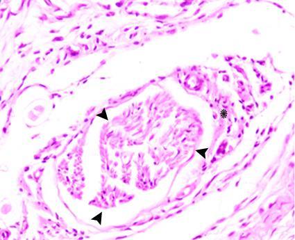 Fig.2 : Light micrograph of a section of the mammary gland epithelia of rats injected with DMBA showing breast carcinoma.