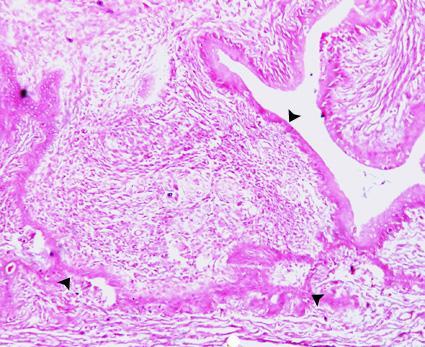 Fig.5: Light micrograph of a section of the mammary gland epithelia of injected DMBA rat and treated with