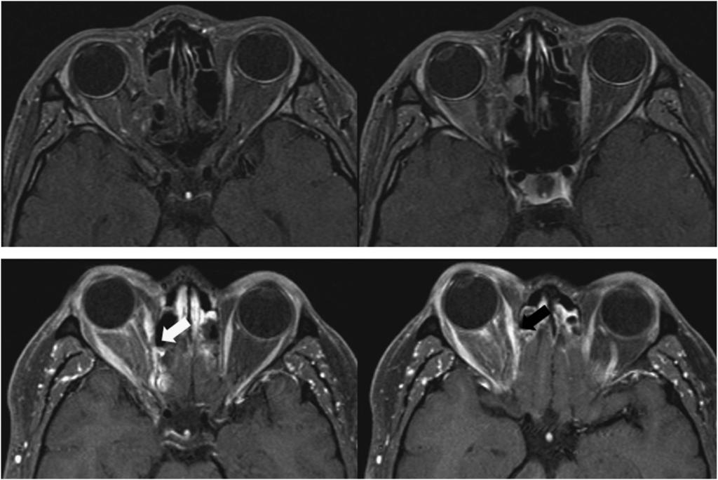 684 Extraocular muscle injury during endoscopic sinus surgery Figure 2 Axial MRI of complete muscle transection (top, case 1) and partial muscle resection (bottom, case 8) cases.