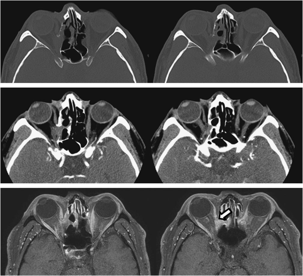 Extraocular muscle injury during endoscopic sinus surgery 685 Figure 3 CT scans and axial MRI of case 11. The mid portion of the muscle segment seems transected on CT scans (top and middle).