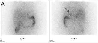 From an analysis of previous studies conducted between 1979 and 2003 which enrolled a total of 686 patients, the mean sensitivity of NP-59 scintigraphy was 86%, the specificity 78% and the accuracy