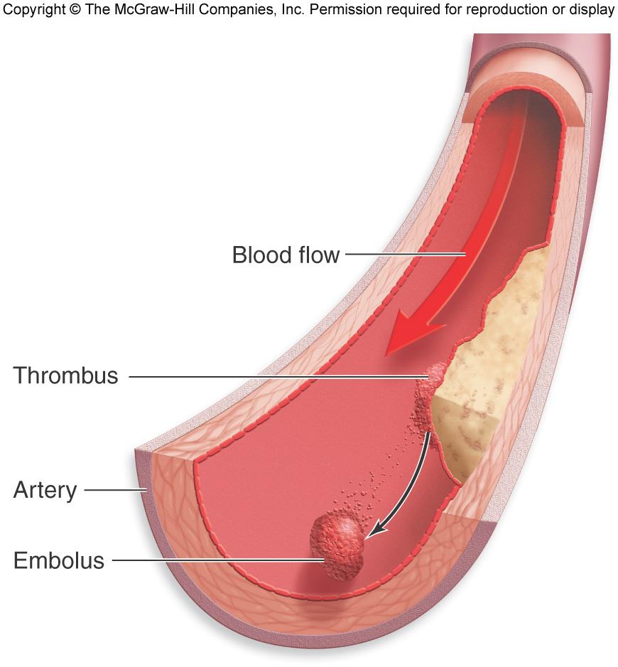 Embolus Formation A thrombus that breaks away and travels through the blood is