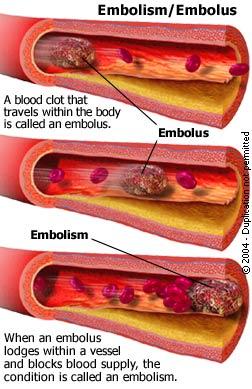 If an embolus lodges in the heart, it can cause a heart attack (myocardial