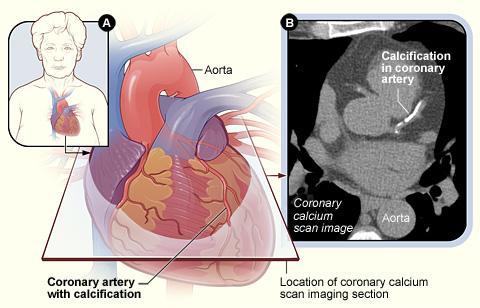 Coronary calcium consists of specks of calcium (tiny calcifications) in arteries of the heart.