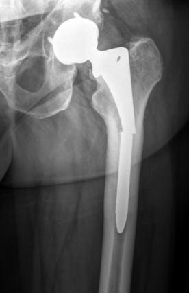 THAR: Implant Removal Well