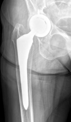 THAR: Acetabular Bone Loss Mild-Moderate Bone
