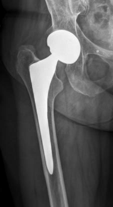 THAR: Femoral Bone Loss Mild-Moderate Bone Loss: What is