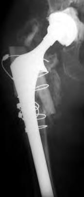 Femoral Bone Loss What is your go to category