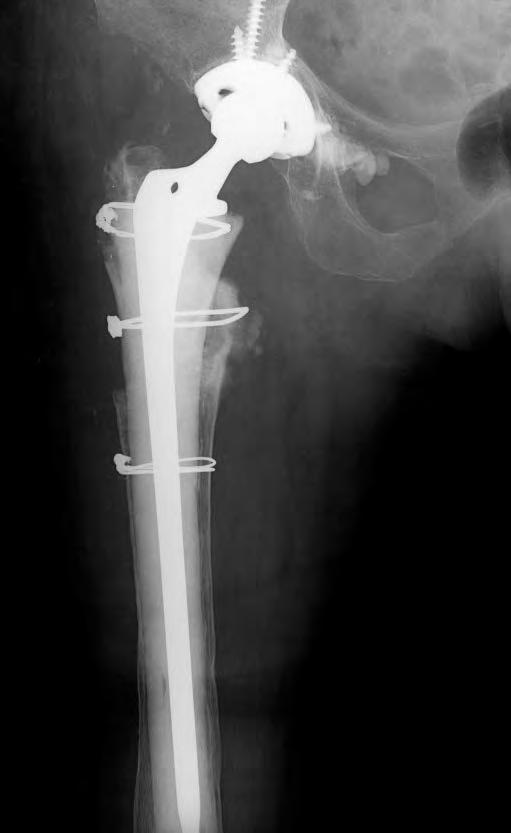 Femoral Bone Loss Is there a role for impacting grafting?