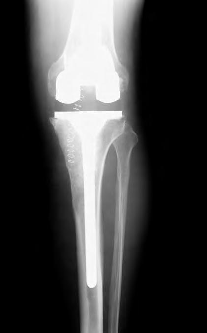 TKAR: Bone Loss - Fixation When do you