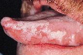 Aphthous ulcers