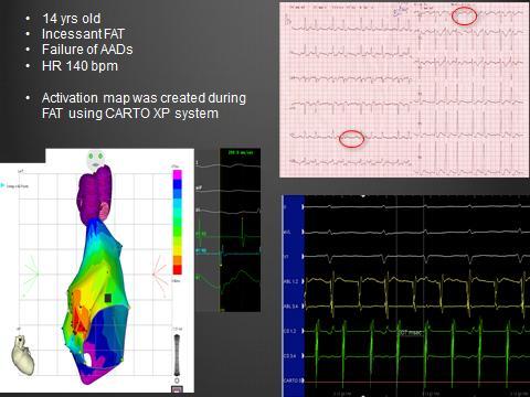 MAPPING AND ABLATION OF AVNRT Elimination of retrograde 1:1 slow AV pathway conduction is the primary goal Ablation is directed to the site of the earliest