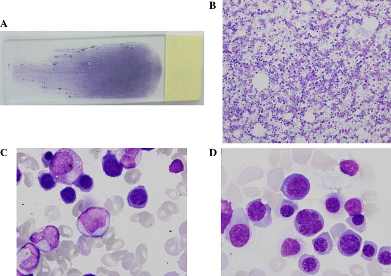 Border between aplastic anemia 559 BM failure. In this review, we refer to benign and preleukemic BM failure syndromes, respectively, as AA and MDS.