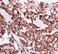 Anti-ERG was found to have high sensitivity for vascular neoplasms. ERG expression has been observed in prostate carcinomas and high-grade prostatic intraepithelial neoplasia (HGPIN).